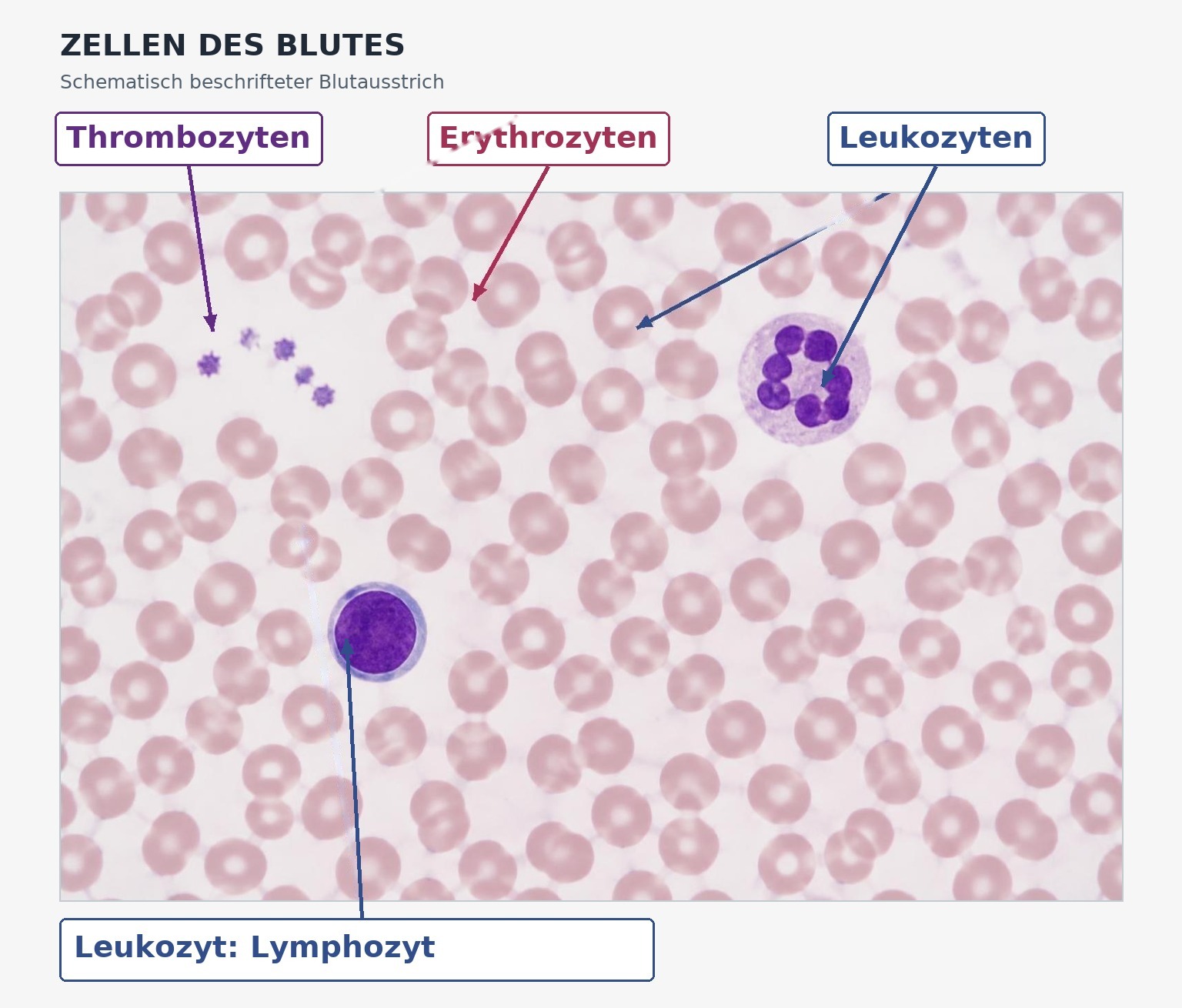 Abb. Beschrifteter Blutausstrich: Pfeile zeigen auf rote Blutkörperchen (Erythrozyten), Blutplättchen (Thrombozyten), einen neutrophilen Granulozyten und einen Lymphozyten. Didaktische, nicht diagnostische Darstellung.
